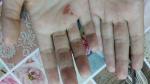Сухие красные пятна на пальцах рук, трещины, зуд фото 1