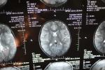 Ночная эпилепсия, головная боль, киста головного мозга фото 3