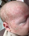 Аллергия, потница или акне новорожденных фото 2