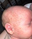 Аллергия, потница или акне новорожденных фото 1