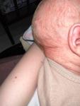 Аллергия, потница или акне новорожденных фото 3