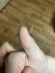 Шелушение (трещины) на пальцах рук фото 5