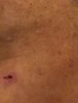 Болячка на лице на одном месте, дермотолог отправил к онкологу фото 2