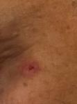 Болячка на лице на одном месте, дермотолог отправил к онкологу фото 3