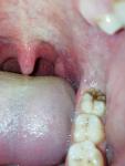 Больной зуб фото 1