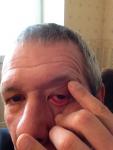 Травма глаза при попадании древесных опилок фото 1