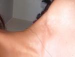 Светлые пятна на коже плеч шеи спины фото 3