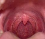 Здорово горло или нет? Нужно ли идти в больницу? фото 1