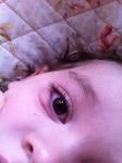 Опухоль под глазом у ребенка фото 1
