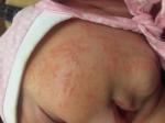Аллергия на цветение у новорожденного фото 1