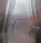 Перелом Внутренней лодыжки со смещением фото 1