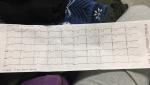 Расшифровать кардиограмму сердца фото 2