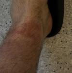 Красные пятна на щиколотке фото 3