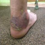 Болячки на ногах у инвалида фото 1