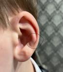 Шишечка на хрящике уха фото 1