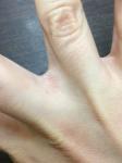 Шелушение между 2 пальцами рук фото 3