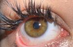 Кератит или инфекция? фото 3