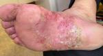 Сильный дерматит на ступнях, красные пятна по телу фото 1