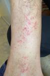 Сильный дерматит на ступнях, красные пятна по телу фото 2
