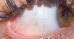 Кератит или инфекция? фото 1