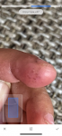 Красно-коричневые точки на пальце фото 2