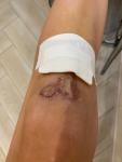 Рана на колене фото 2