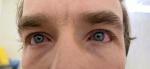 Покраснения глаз и желтые выделения после ОРВИ фото 4