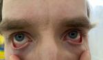 Покраснения глаз и желтые выделения после ОРВИ фото 1