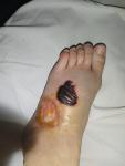 Гнойные раны на ногах фото 2