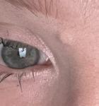 Липома/жировик/атерома? фото 2