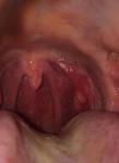 Частые периодические боли в горле фото 4