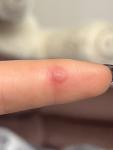Вскочило пятно на пальце, очень болит фото 2