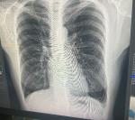 Рентген лёгких фото 1
