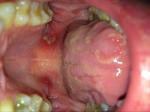 Болит нёбо после удаления зуба фото 1