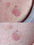 Меланома или дерматит, выросло на пигментном пятне фото 1