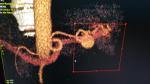 Аневризма селезеночной артерии фото 1