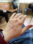 Проблемы с кожей на руках, ладонях и животе фото 2