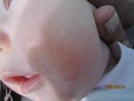 Высыпания у грудного ребёнка фото 1