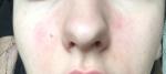 Сыпь, покраснение, шелушение около носа как треугольник фото 1
