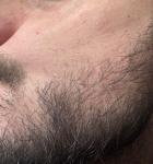 Шелушіння на обличчі фото 1