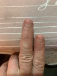 Болезнь ногтей фото 2