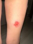Появилась красная болячка после укуса комара фото 2