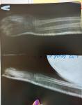 Перелом лучевой кости на руке фото 1