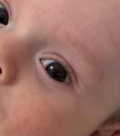 Красная точка в глазу фото 1