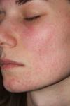 Покраснения кожи лица, дерматит фото 2