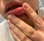 Пузыри на внутренней стороне губы фото 1