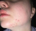 Сыпь на лице (нижняя челюсть) фото 2