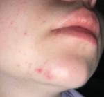 Сыпь на лице (нижняя челюсть) фото 1