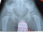 Расшифровать рентгеновский снимок на наличие дисплазии ТБС фото 2
