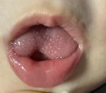 Сыпь на языке у ребёнка в 1,7 фото 1